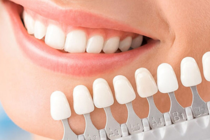 Facetas Dentárias